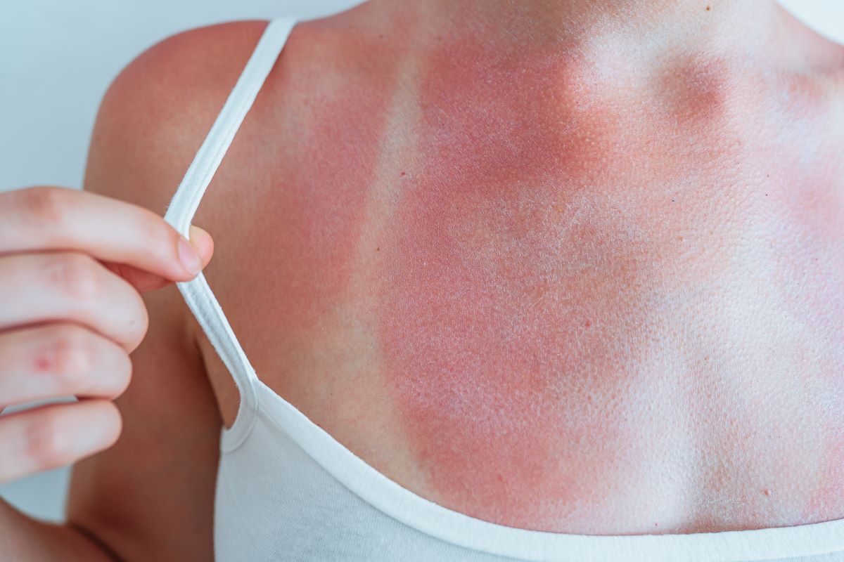 Sonnenbrand in Pforzheim – Schützen, erkennen und richtig be